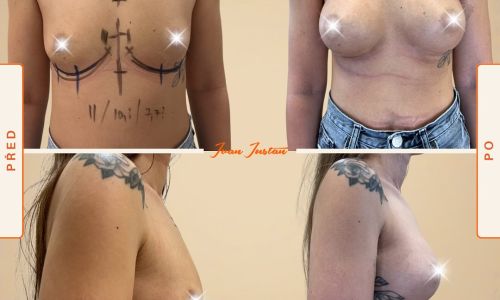 přirozené zvětšení prsou anatomickým silikonovým implantátem