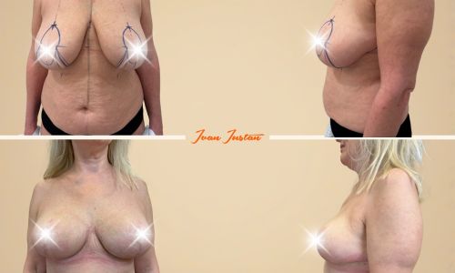 modelace prsů