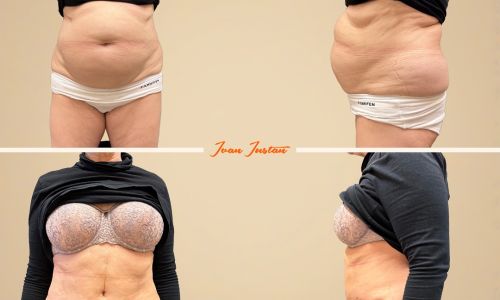 operace převisu břicha s upravou svaloviny