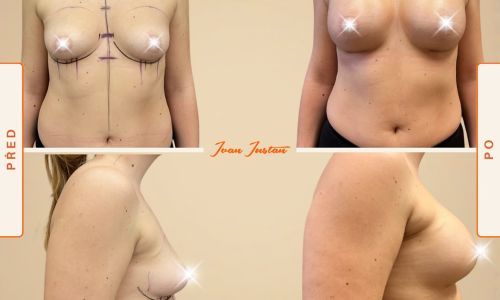 zvětšení prsou anatomickým implantátem