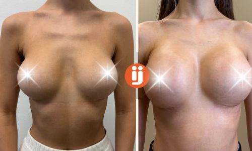 zvětšení prsou kulatým implantátem