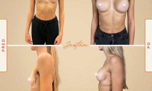 zvětšení prsou kulatým implantátem 